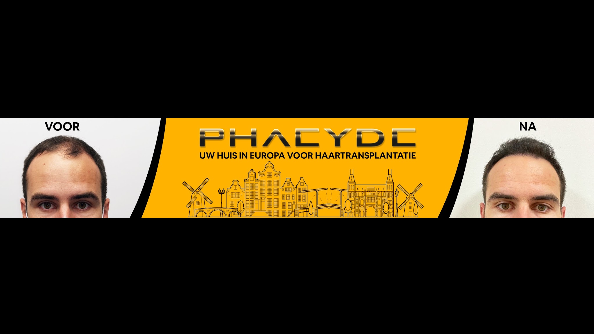 Haartransplantatie - PHAEYDE Kliniek YouTube banner