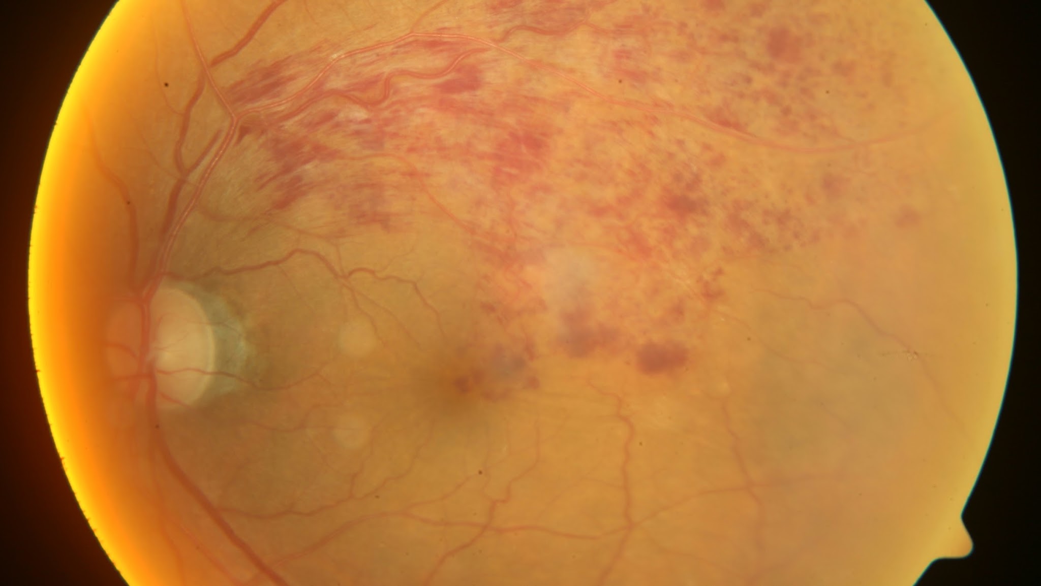 Mayank Bansal MD FRCS, Eye Vitreo-Retinal Surgeon YouTube banner